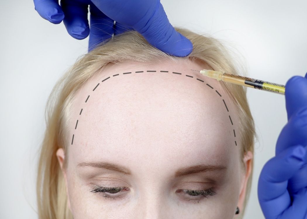 Girin Plastic Surgery - Hair transplant 1000 graft (incisional) - Jivaka  Beauty